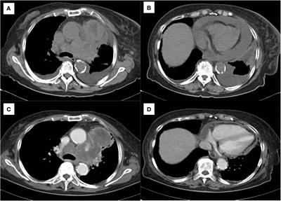 Successful treatment of extensive-stage small cell lung cancer with concurrent pleural and pericardial effusions: Case report
